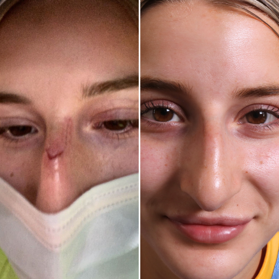 Before and After Image: Scar Tx with Palomar 1540 - front