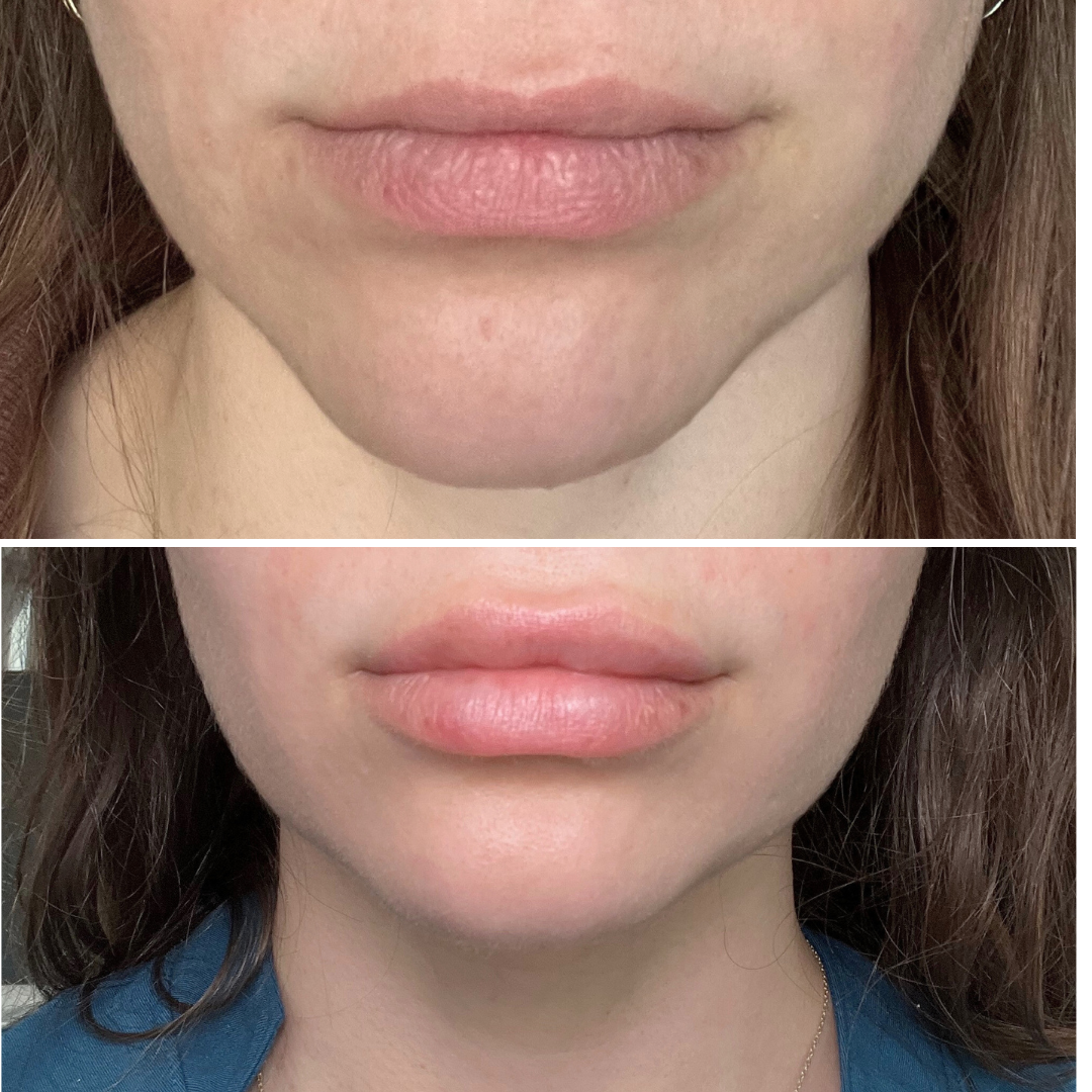 Before and After Image: Versa Lip Filler - front